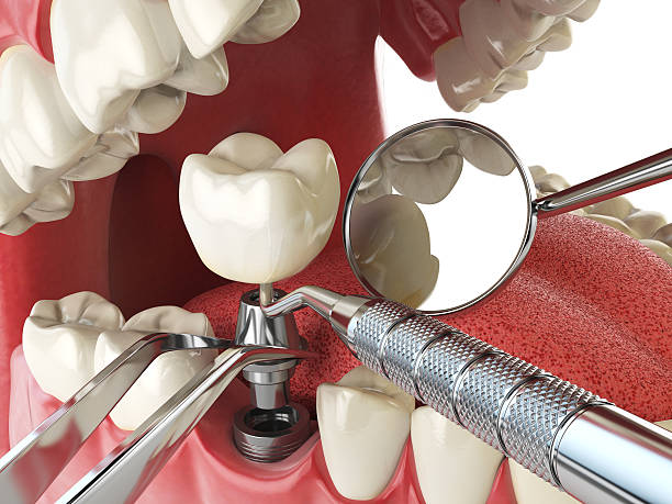 Best Emergency Root Canal Treatment in Ganado, TX